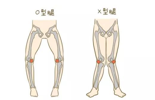 O型腿X型腿.jpeg